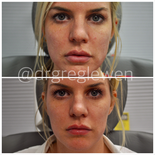 Botox Before and After Pictures Miami, FL