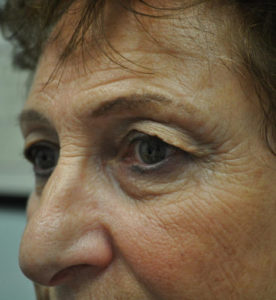 Blepharoplasty Before and After Pictures Miami, FL