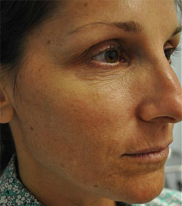 IPL PhotoFacial Before and After Pictures Miami, FL