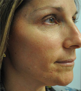 IPL PhotoFacial Before and After Pictures Miami, FL