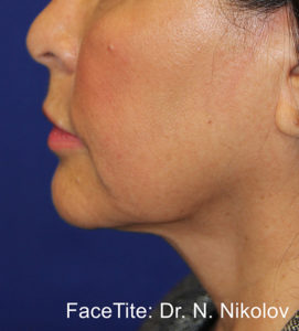 Facetite and Accutite Before and After Pictures in Miami, FL