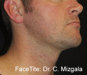 Facetite and Accutite Before and After Pictures in Miami, FL