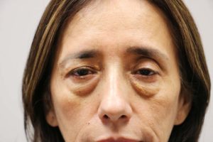 Lower Blepharoplasty and Xanthelasma patient 1 - before photo