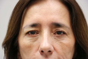 Lower Blepharoplasty and Xanthelasma patient 1 - after photo