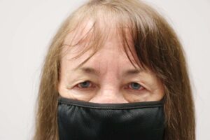 Blepharoplasty - patient 16 - before photo