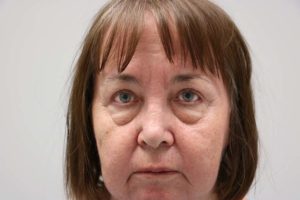 Blepharoplasty - patient 16 - after photo