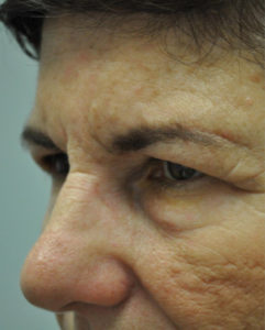 Blepharoplasty