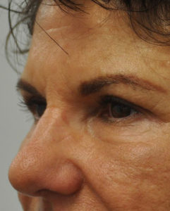 Blepharoplasty