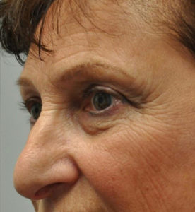 Blepharoplasty