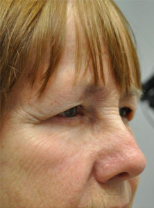 Blepharoplasty