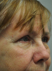 Blepharoplasty