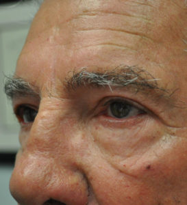 Blepharoplasty