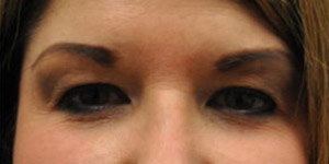 Blepharoplasty