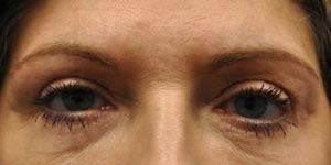 Blepharoplasty