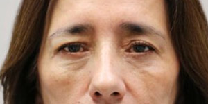 Blepharoplasty