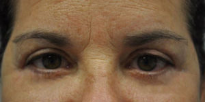 Blepharoplasty