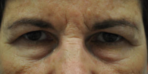 Blepharoplasty