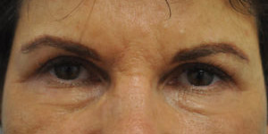 Blepharoplasty