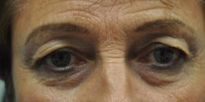 Blepharoplasty