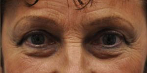 Blepharoplasty