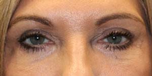 Blepharoplasty