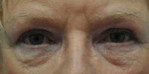 Blepharoplasty