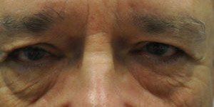 Blepharoplasty