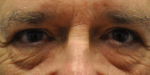 Blepharoplasty