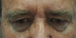 Blepharoplasty