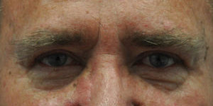 Blepharoplasty