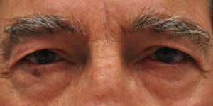 Blepharoplasty