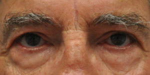 Blepharoplasty