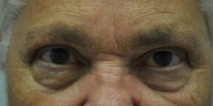 Blepharoplasty