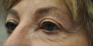 Blepharoplasty