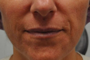 Dermal Fillers and Injectables