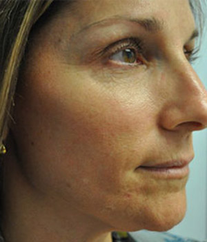 IPL PhotoFacial