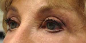 Blepharoplasty