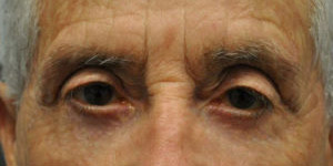 Blepharoplasty