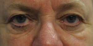 Blepharoplasty