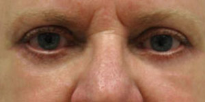 Blepharoplasty