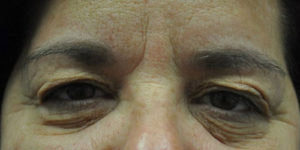 Blepharoplasty