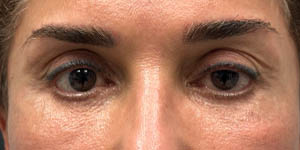 _0000_PATIENT 3 BEFORE SUBBROW FILLER.PNG