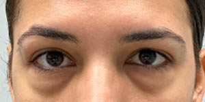 _0000_Patient 1 before Lower Bleph with micro Fat Grafting.jpg