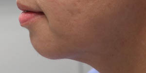 _0000_patient 1 after chin and jawline filler.PNG