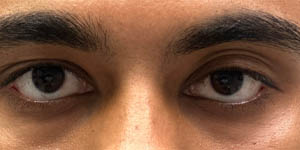 _0000_patient 1 before left upper lid ptosis repair with subbrow filler.PNG