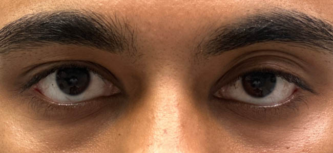 _0000_patient 1 before left upper lid ptosis repair with subbrow filler.PNG
