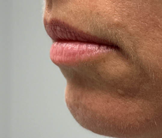 _0000_patient 1 before lip filler (left side).PNG
