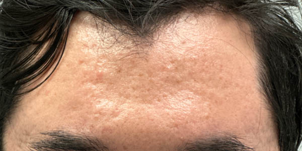 _0000_patient 1 before m8 (front).PNG