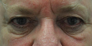 _0000_patient 1 before upper and lower bleph.PNG