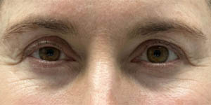 _0000_patient 1 before upper bleph with subbrow filler.PNG